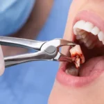 Dental Surgical Treatment