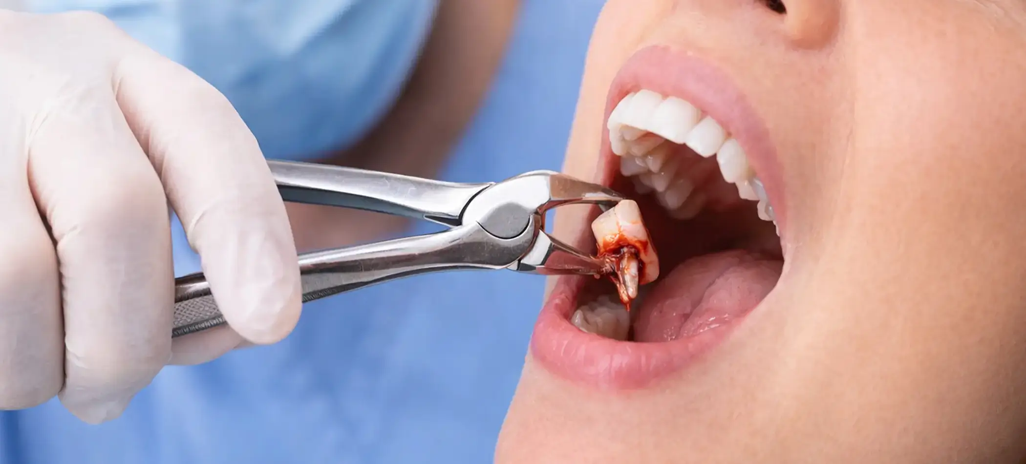 Dental Surgical Treatment
