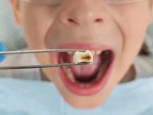 dental surgical tooth extraction