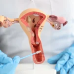 Gynecological filler