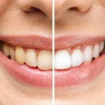 Teeth Whitening