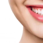 thumb-Hollywood Smile