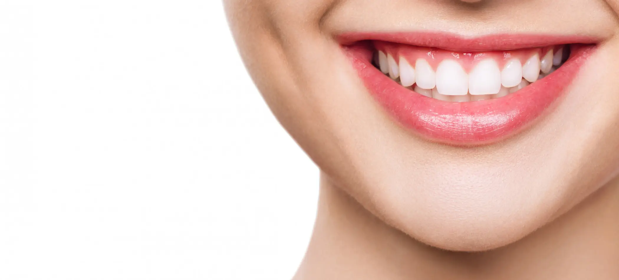 Hollywood Smile (Veneers)
